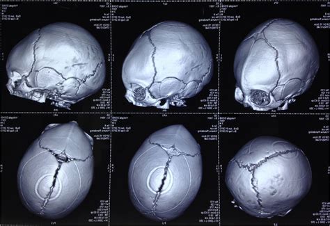 Строение черепа ребенка (много фото) - artshots.ru