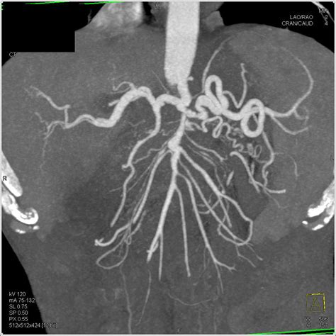 Pancreatic Cancer With Liver Metastases Adenopathy And Carcinomatosis