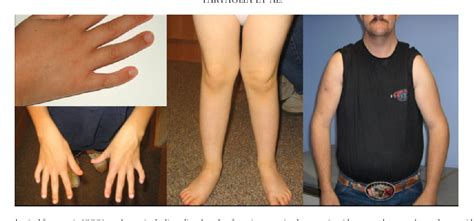 Figure 2 From A New Look At Xxyy Syndrome Medical And Psychological