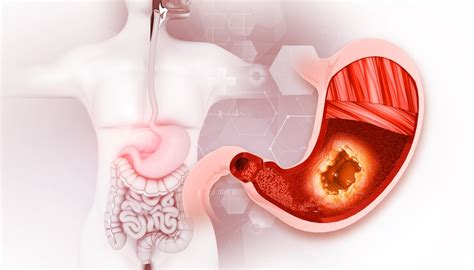 Sugemalimab y quimioterapia: un avance en el cáncer gástrico avanzado