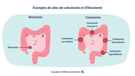 Tout Comprendre Sur Les Colostomies Et Les Il Ostomies