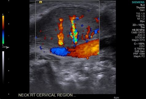 Fibromatosis Colli Pacs