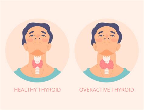 Understanding Thyroid Symptoms Causes And Treatments