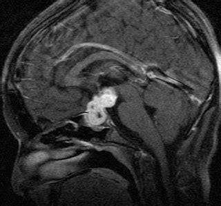 Lymphocytic Hypophysitis-MRI - Sumer's Radiology Blog