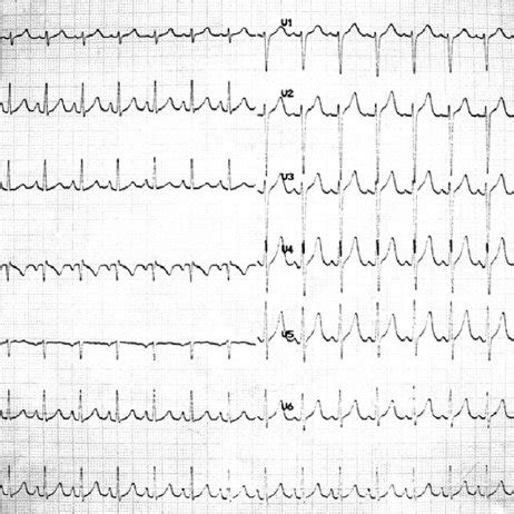 (PDF) Widening of the QRS Complex Due to Severe Hyperkalemia as an Acute Complication of ...