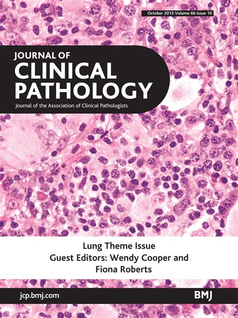 Smoking-related interstitial fibrosis (SRIF): pathologic findings and