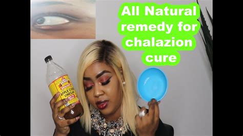 All Natural Home Remedy For Getting Rid Of Chalazion In Just 3 Days