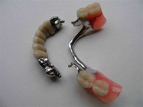 Верхний Бюгельный Протез На Замках Фото — Фото Картинки