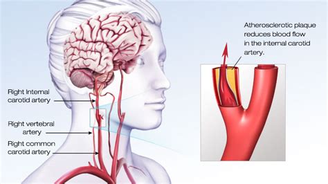 ischemic stroke symptoms  treatment pacific stroke neurovascular