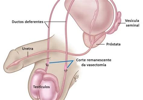Tem Como Reverter A Vasectomia - Saiba mais sobre Reversão de Vasectomia | Dr. Tiago Mierzwa