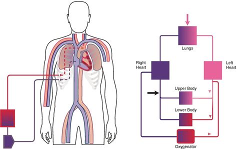 Configurations Of Ecmo Alfred Ecmo Guideline