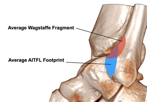 Schematic illustration of average footprint of AITFL compared to the ...