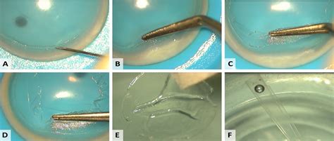 Donor Tissue Preparation For Bowman Layer Transplantation Cornea