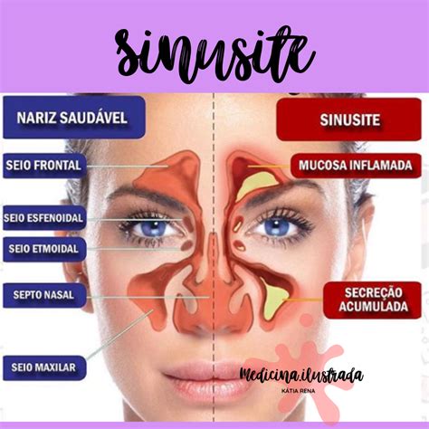 Sinusite E Ar Condicionado - Sinusite - Fisiologia II