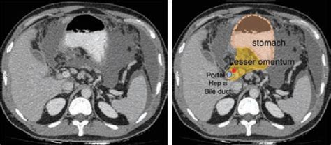 Imaging Illustration Of Anatomy Of Lesser Omentum Download