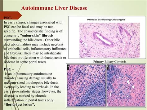 Autoimmune Liver Disease Laboratory Diagnosis PPT