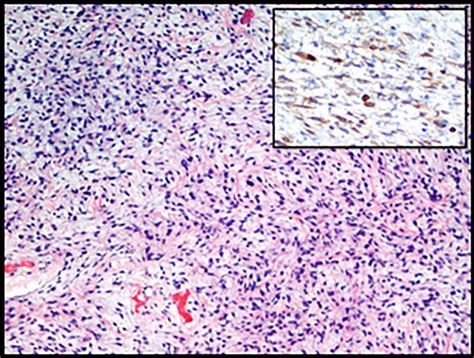 Paratesticular Mass