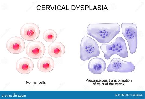 Cervical Dysplasia Cervical Cancer Stock Vector Illustration Of