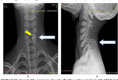 Figure 2 from UNILATERAL HYPERPLASIA OF LAMINA AND SPINOUS PROCESS OF ...