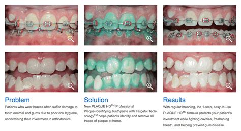 Plaque HD: A toothpaste that dyes my teeth?! | McLean Family Dentistry