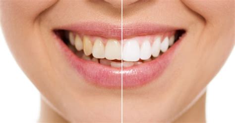 Common Cosmetic Dentistry Procedures Love Your Smile Seattle Wa