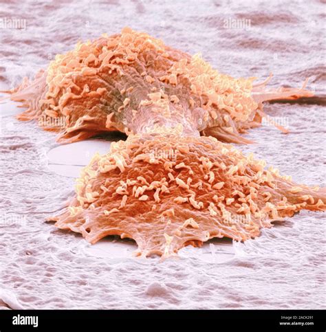 Dividing Cancer Cells Coloured Scanning Electron Micrograph Sem Of Colorectal Cancer Cells