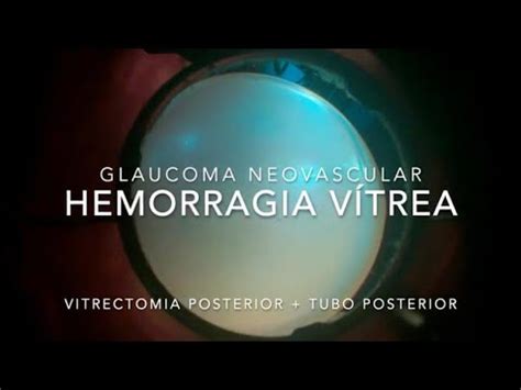 Implante De Tubo Ahmed Vitrectomia Posterior Pars Plana Glaucoma