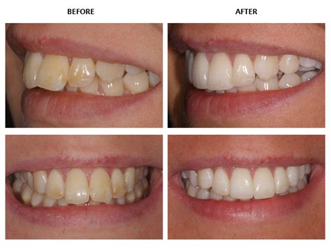 Inman Aligner before and after pictures - Inman Aligner