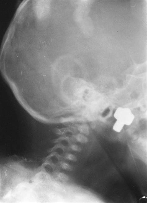 Nasopharynx X Ray 2