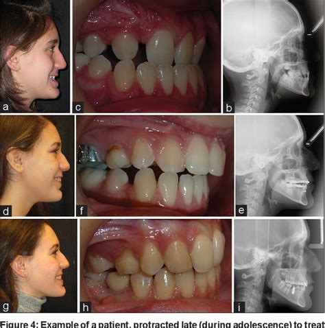 Figure 4 from Treatment of maxillary hypoplasia in cleft lip and palate ...