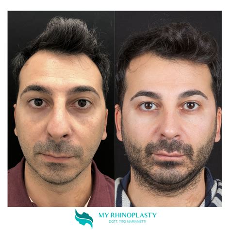 Cartilagine Alare Naso Gonfia 1 My Rhinoplasty