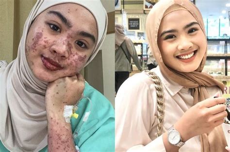 Viral Di Tiktok Ini Pengalaman Afina Syifa Saat Kena Steven Johnson