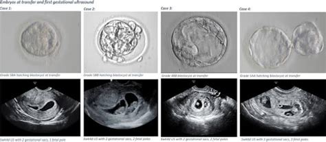 Procedures After Embryo Transfer Day By Day Aastha Fertility