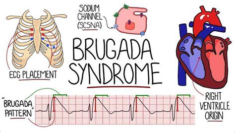 Brugada Syndrome Medizzy