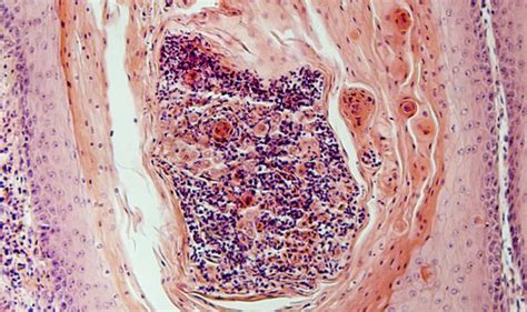 Anal Cancer THESE Are The Symptoms Of Rare Disease Linked To HPV Virus