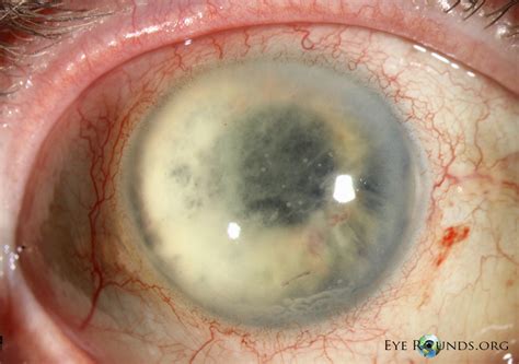 Atlas Entry Delayed Postoperative Fungal Endophthalmitis