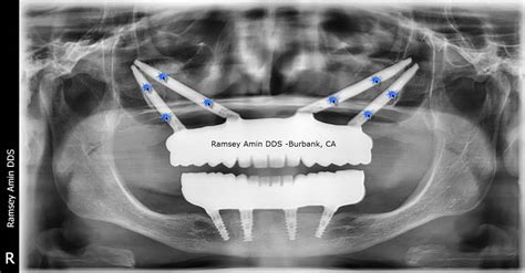 zygomatic process radiograph