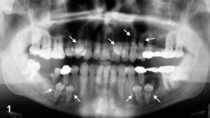 Supernumerary Teeth (Hyperdontia) - Numbering Chart and Removal