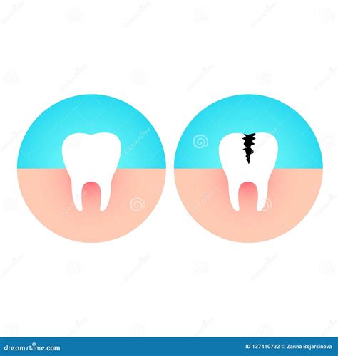 Gezonde En Beschadigde Tand Bederfziekte Vector Illustratie