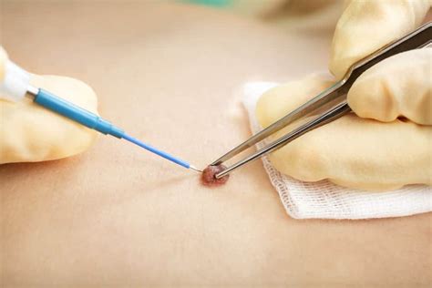 Mole Removal London (£345) - Skin Cancer Plastic Surgeon