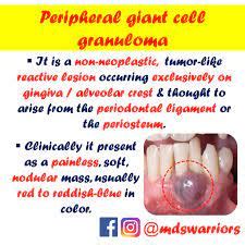 Giant cell granuloma | DentMistry