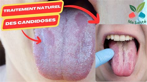 Traitement Naturel Des Candidoses Candida Albicans Candidose Buccal