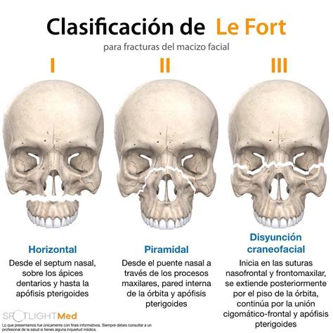 Classificação De Le Fort