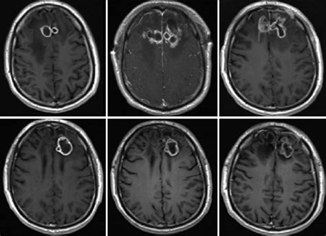 Serial Mri T Sequence With Contrast Showing The Disease Course Over