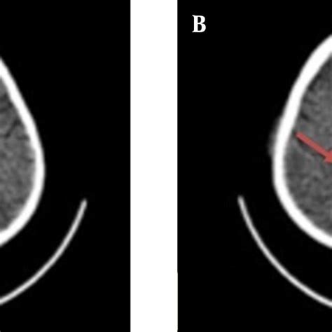 Head Computed Tomography Ct Scan With Contrast A Cerebral Download Scientific Diagram