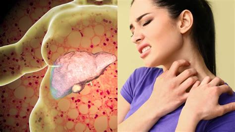 signs  liver damage  ways   dr srivatsan gurumurthy