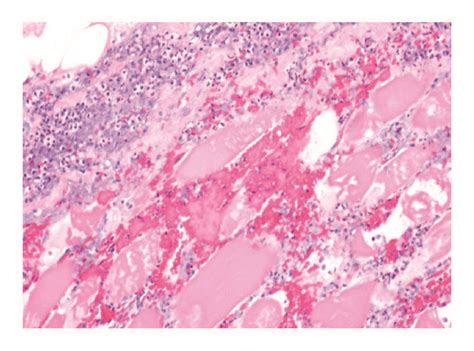 Histological Section Of The Muscle Biopsy Showing Intense Neutrophilic