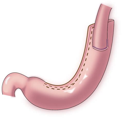 Frontiers Cardia Function Preserving Surgery And Anti Reflux