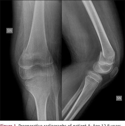 Figure 1 From Flexible Intramedullary Nailing For Supracondylar Femoral