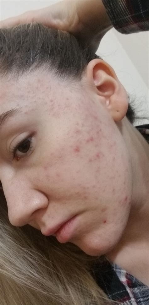 how to get rid of whiteheads overnight 5